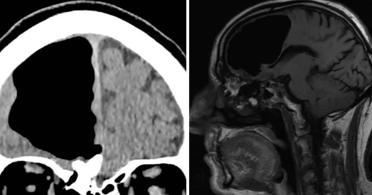 Doctors Discover Air Pocket in Man’s Skull, Part of His Brain Missing