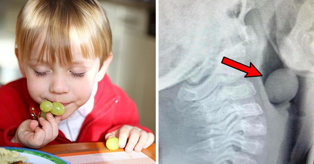Blogger Shares Xray Of A Grape Stuck In Boy's Throat To Warn Against